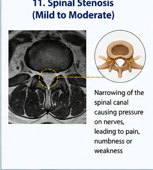 Lumbar spine medical illustration