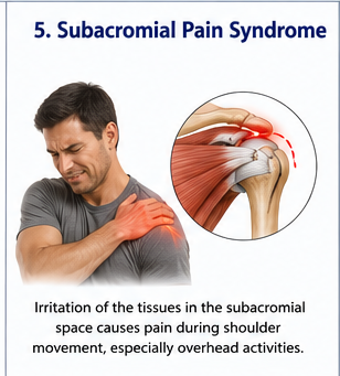 Subacromial shoulder pain